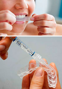 blanqueamiento dental en casa